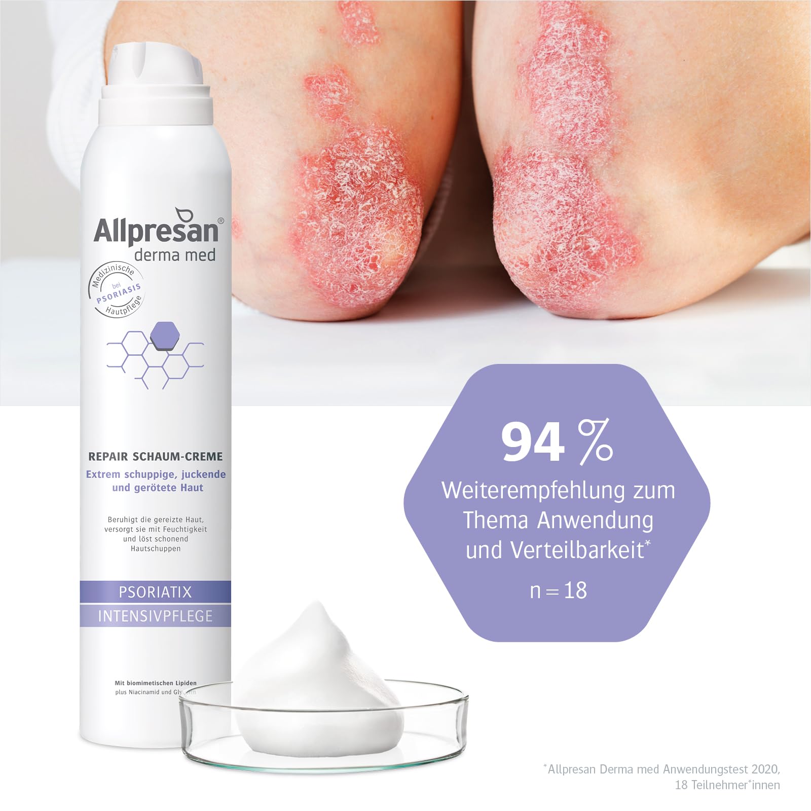allpresan-psoriatix-repair-schaum-creme-200-ml-bei-psoriasis image 5